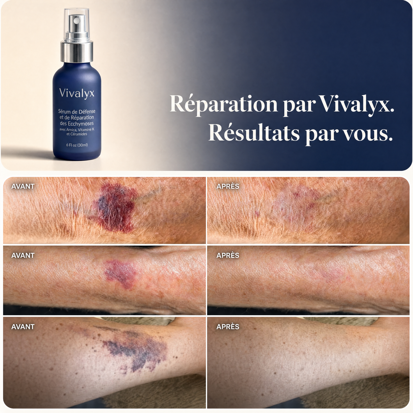 Vivalyx Sérum de Défense et Réparation des Ecchymoses